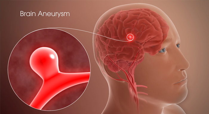 علائم آنوریسم عروق مغزی