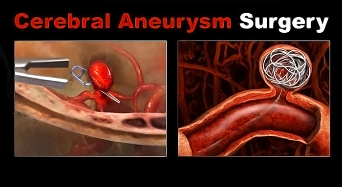 درمان و جراحی آنوریسم عروق مغزی