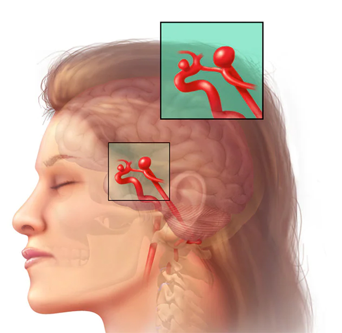  آنوریسم عروق مغزی