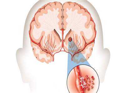 خونریزی مغزی به چه معناست؟ آیا درمان دارد؟